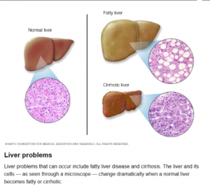 Liver Risk Study | Health Atmos